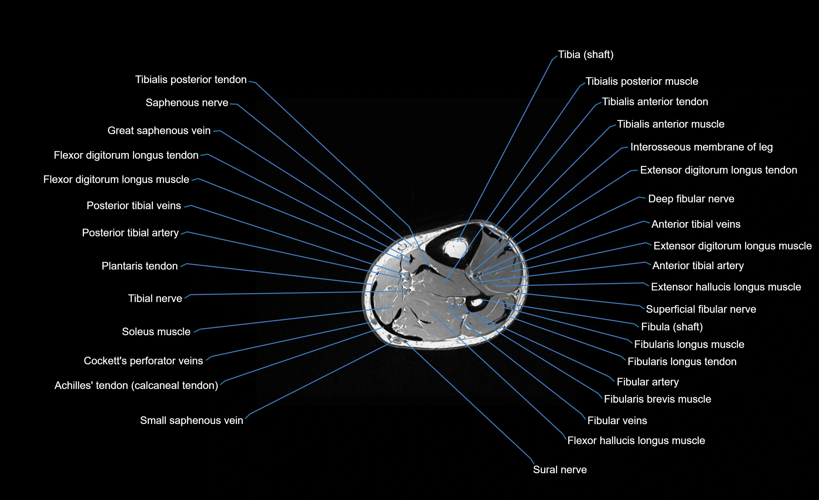 MRI lower leg axial cross sectional anatomy 3T  radiology  image-img-00001-00072.webp